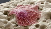 موفقیت محققان دانشگاهی در تخریب سلول‌های سرطانی با امواج فراصوت
