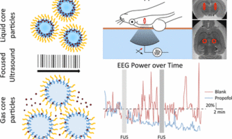 انفجار ایمن نانوحامل زیست‌سازگار در مغز با امواج فراصوت