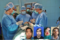 در تهران انجام شد: جراحی بازسازی صورت با ساخت اسکلت سه بعدی بینی