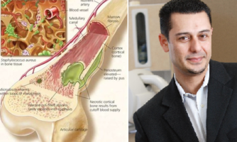 ابداع ترکیب دارویی درمان عفونت استخوانی توسط دانشمند ایرانی