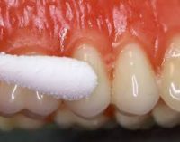 کاهش فوری دردهای دندان با پانسمان حبابی محققان ایرانی