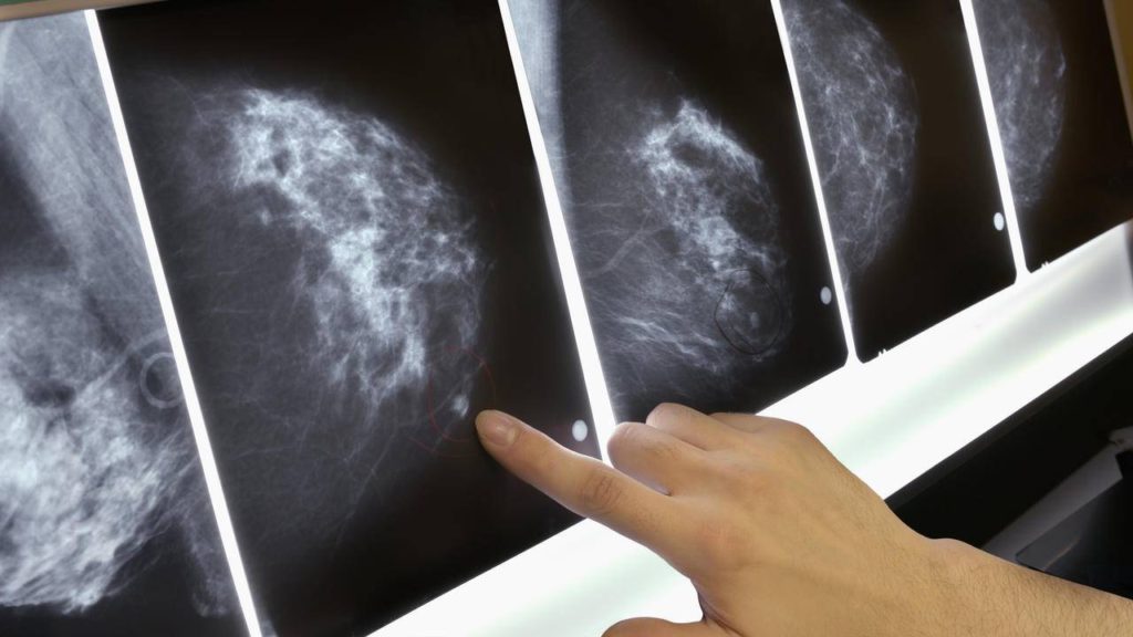 دستاورد محققان ایرانی در تشخیص زودهنگام سرطان پستان بدون برداشت بافت