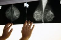 سن بروز سرطان پستان زنان ايراني ۱۵ سال کمتر از کشورهای غربی/ضرورت معاینه سالانه پستانها از ۴۰ سالگی