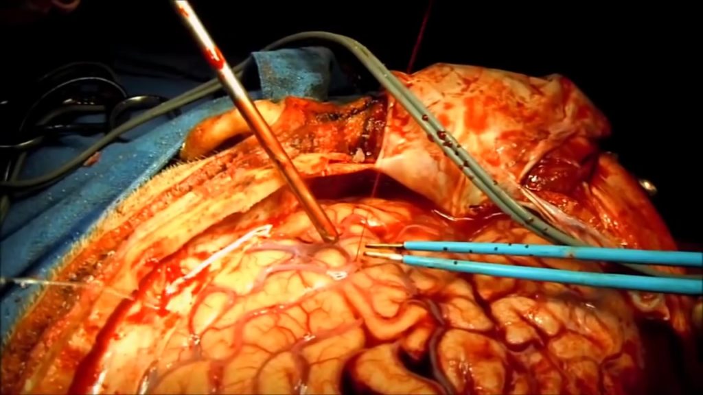 نخستین کورس جراحی عروق مغزی در کشور