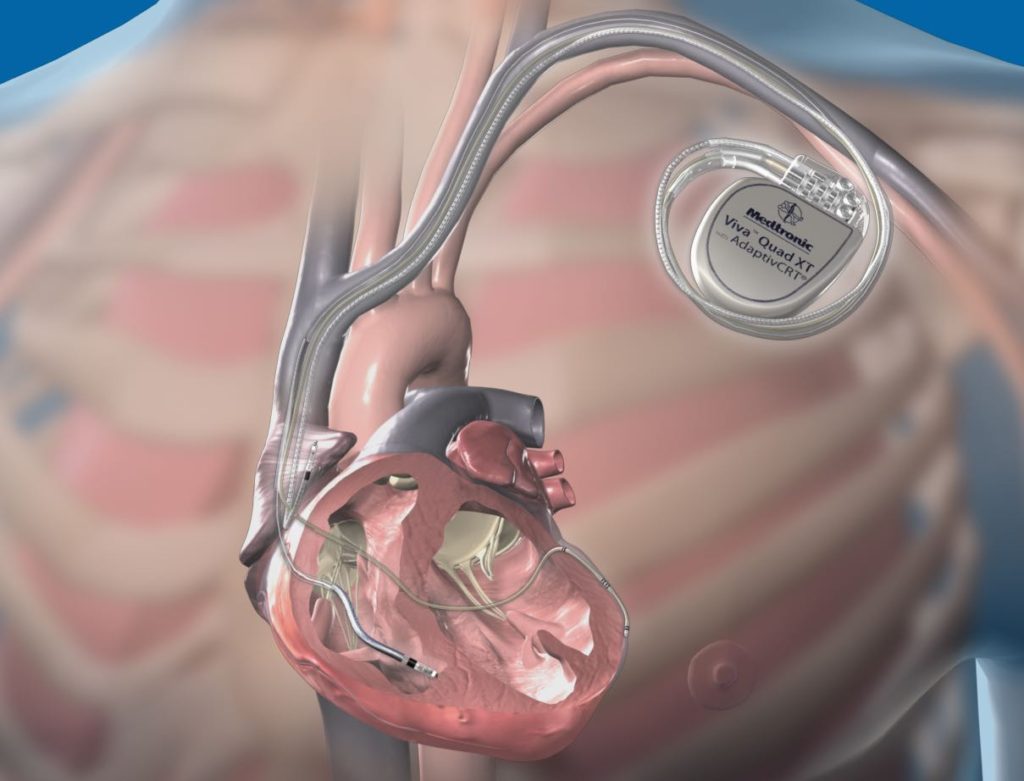 نصب ضربان ساز اپی کاردیال قلب به روش توراسکوپی برای نخستین بار در کشور