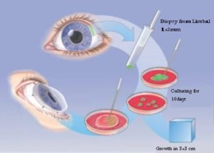 در پژوهشگاه رویان محقق شد: بهبود عمل پیوند لیمبال قرنیه با قطره چشمی عصاره غشاء آمنیوتیک