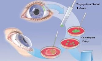در پژوهشگاه رویان محقق شد: بهبود عمل پیوند لیمبال قرنیه با قطره چشمی عصاره غشاء آمنیوتیک