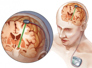 نخستین جراحی درمان وسواس در ایران انجام شد/تولید الکترودهای مغزی در ایران در مرحله آزمایش حیوانی