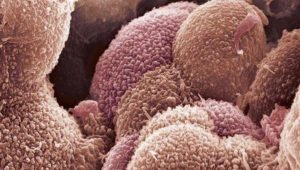 تشخیص زودهنگام سرطان تخمدان با آپتاحسگر محققان دانشگاهی