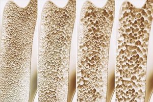 تلاش محققان دانشگاهی برای تشخیص زودهنگام پوکی استخوان با تراشه‌های ناخن