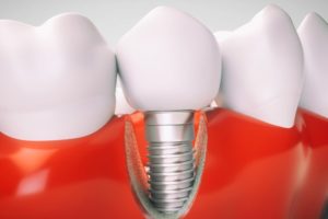 ساخت ایمپلنت دندانی بهینه از سوی محققان دانشگاه صنعتی امیرکبیر