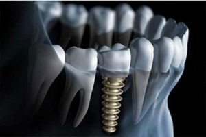 طراحی ایمپلنت دندانی با ابعاد استخوانی فردی در دانشگاه آزاد