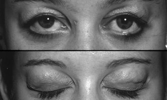 با تست ابداعی چشم پزشک ایرانی میسر شد: تشخیص افتادگی غده اشکی در افراد با پف پلک