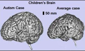 رشد بیش از حد مغز می تواند در اوتیسم نقش داشته باشد