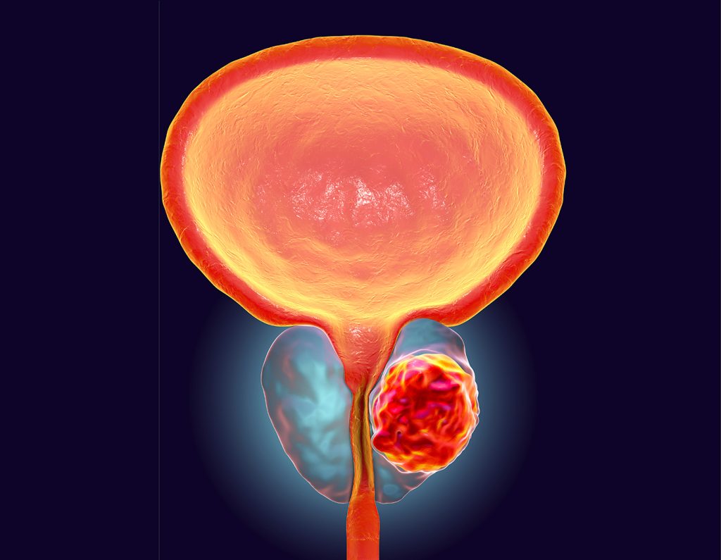 تشخیص سلولهای سرطانی توسط جراح با رنگ نشانه گذار فلوروسنت
