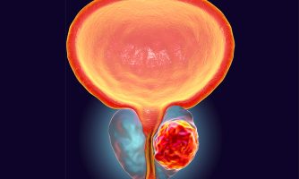 تشخیص سلولهای سرطانی توسط جراح با رنگ نشانه گذار فلوروسنت
