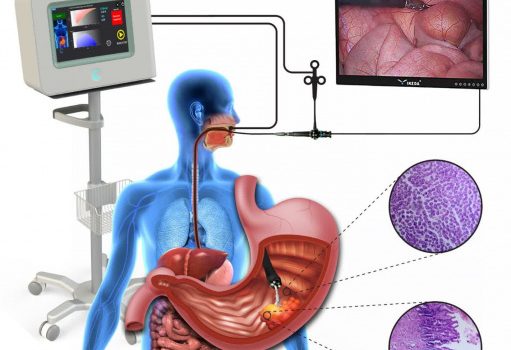 ساخت دستگاه تشخیص دقیق سرطانهای دستگاه گوارش فوقانی در کشور